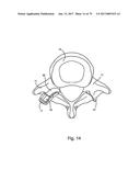 Linked Bilateral Spinal Facet Implants and Methods of Use diagram and image