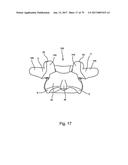 Linked Bilateral Spinal Facet Implants and Methods of Use diagram and image