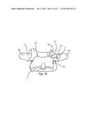 Linked Bilateral Spinal Facet Implants and Methods of Use diagram and image