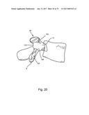 Linked Bilateral Spinal Facet Implants and Methods of Use diagram and image