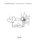 Linked Bilateral Spinal Facet Implants and Methods of Use diagram and image