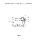 Linked Bilateral Spinal Facet Implants and Methods of Use diagram and image