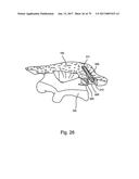 Linked Bilateral Spinal Facet Implants and Methods of Use diagram and image