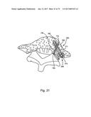 Linked Bilateral Spinal Facet Implants and Methods of Use diagram and image