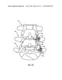 Linked Bilateral Spinal Facet Implants and Methods of Use diagram and image