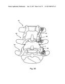 Linked Bilateral Spinal Facet Implants and Methods of Use diagram and image