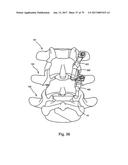 Linked Bilateral Spinal Facet Implants and Methods of Use diagram and image