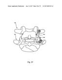 Linked Bilateral Spinal Facet Implants and Methods of Use diagram and image