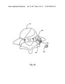 Linked Bilateral Spinal Facet Implants and Methods of Use diagram and image