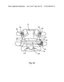 Linked Bilateral Spinal Facet Implants and Methods of Use diagram and image