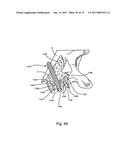 Linked Bilateral Spinal Facet Implants and Methods of Use diagram and image