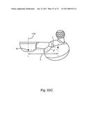 Linked Bilateral Spinal Facet Implants and Methods of Use diagram and image