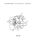 Linked Bilateral Spinal Facet Implants and Methods of Use diagram and image