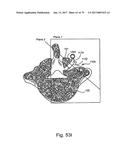 Linked Bilateral Spinal Facet Implants and Methods of Use diagram and image