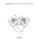 Linked Bilateral Spinal Facet Implants and Methods of Use diagram and image