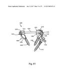 Linked Bilateral Spinal Facet Implants and Methods of Use diagram and image