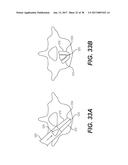 EXPANDABLE INTERBODY SPACER diagram and image