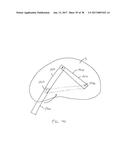 EXPANDABLE INTERBODY SPACER diagram and image