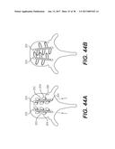 EXPANDABLE INTERBODY SPACER diagram and image