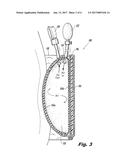 UTERINE COMPRESSION DEVICES AND METHODS diagram and image