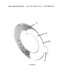 Ostomy Appliance Collar diagram and image