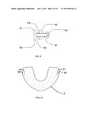 Intraoral Orthosis Device and Method for Manufacturing diagram and image