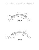 OPHTHALMOLOGICAL APPARATUS FOR THE BREAKDOWN OF EYE TISSUE diagram and image