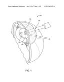 Cataract Posterior/Wedge Chopper diagram and image