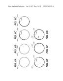 LASER ASSISTED CATARACT SURGERY diagram and image