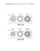 LASER ASSISTED CATARACT SURGERY diagram and image