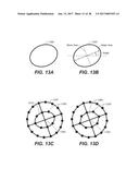 LASER ASSISTED CATARACT SURGERY diagram and image