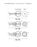 LASER ASSISTED CATARACT SURGERY diagram and image