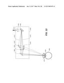 LASER ASSISTED CATARACT SURGERY diagram and image