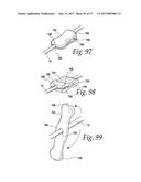 FLUSHABLE CATHETERS diagram and image