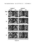 Improved Methods for the Treatment of Vascularizing Cancers diagram and image