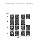 Improved Methods for the Treatment of Vascularizing Cancers diagram and image