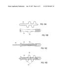 BONE IMPLANT AND SYSTEMS THAT CONTROLLABLY RELEASES SILVER diagram and image