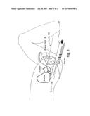 TRANSPERINEAL NEEDLE GUIDANCE diagram and image