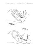 DEVICE FOR TREATING SHOULDER DYSTOCIA diagram and image