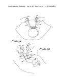 DEVICE FOR TREATING SHOULDER DYSTOCIA diagram and image