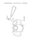 SHAPE ADAPTABLE INTRAMEDULLARY FIXATION DEVICE diagram and image