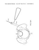 SHAPE ADAPTABLE INTRAMEDULLARY FIXATION DEVICE diagram and image