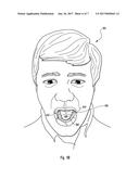 NON-CUSTOM DENTAL TRAY HAVING ANATOMICAL CUSPID-BICUSPID CUTS AND/OR V OR     U-SHAPED INDENTATION IN BOTTOM WALL diagram and image