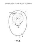 OSTOMY POUCH APPLIANCE diagram and image