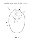 OSTOMY POUCH APPLIANCE diagram and image