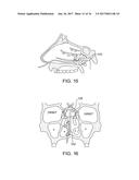 METHODS AND SYSTEMS FOR TOXIN DELIVERY TO THE NASAL CAVITY diagram and image