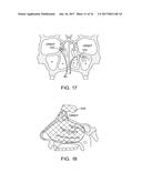 METHODS AND SYSTEMS FOR TOXIN DELIVERY TO THE NASAL CAVITY diagram and image