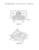 METHODS AND SYSTEMS FOR TOXIN DELIVERY TO THE NASAL CAVITY diagram and image