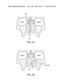 METHODS AND SYSTEMS FOR TOXIN DELIVERY TO THE NASAL CAVITY diagram and image