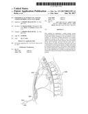 SUBSTERNAL PLACEMENT OF A PACING AND/OR DEFIBRILLATING ELECTRODE diagram and image